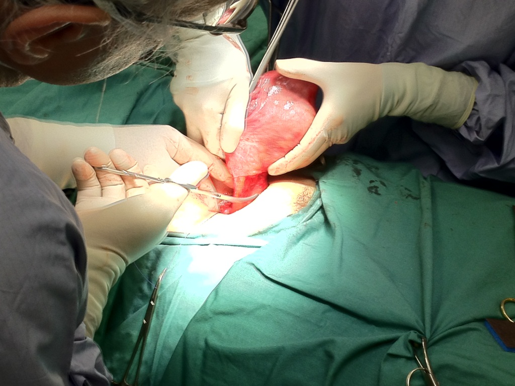 hysterectomy-treatment