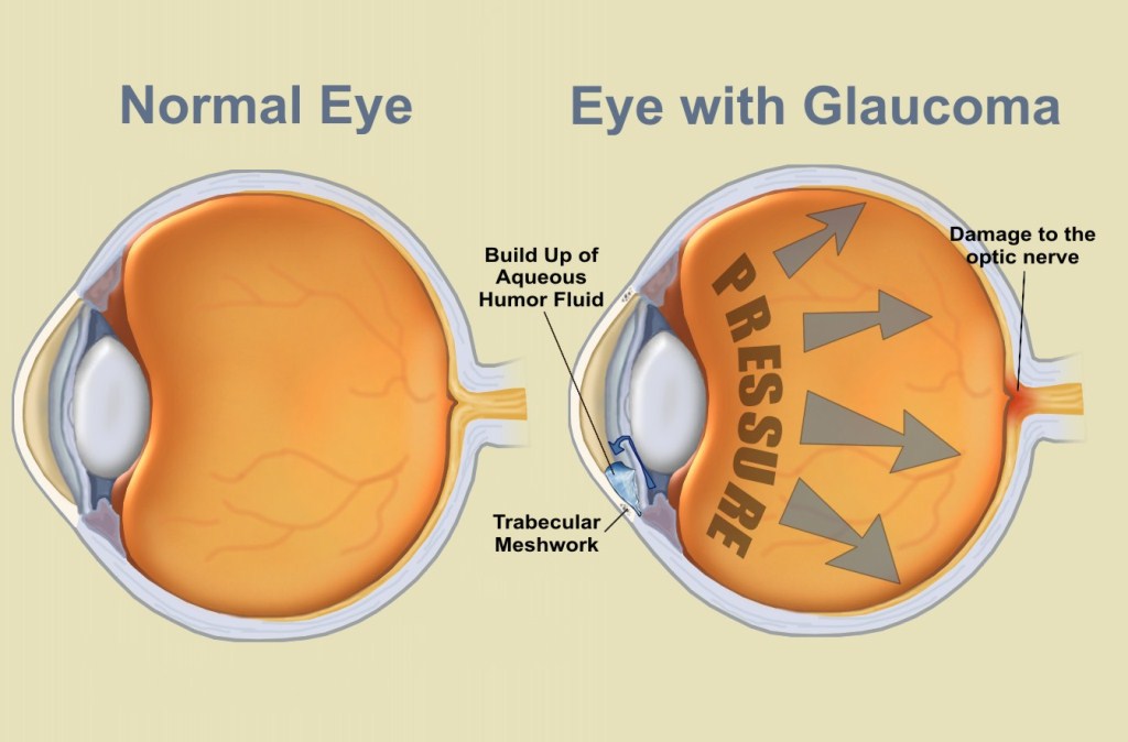 Glaucoma-treatment